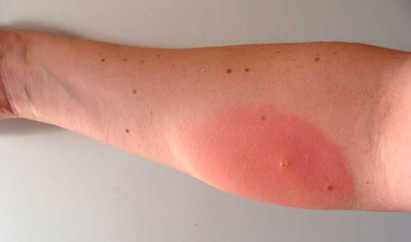 Укус мошки чем лечить и как снять отек, как избежать укуса мошки Укус мошки чем лечить и как снять отек, как избежать укуса мошки